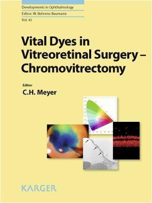 Vital Dyes in Vitreoretinal Surgery(English, Electronic book text, unknown)