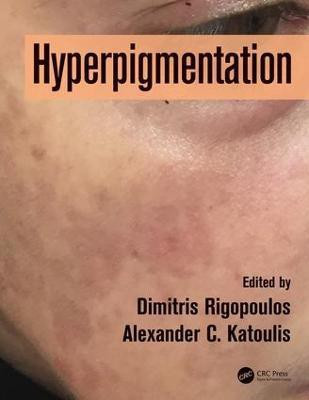 Hyperpigmentation(English, Hardcover, unknown)