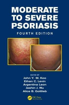 Moderate to Severe Psoriasis(English, Hardcover, unknown)
