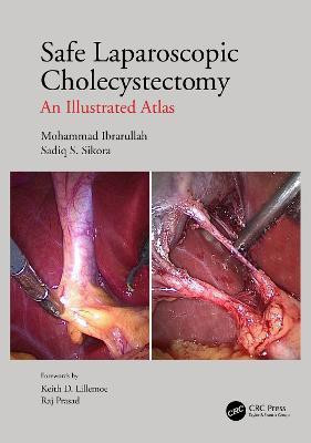 Safe Laparoscopic Cholecystectomy(English, Hardcover, Ibrarullah Mohammad)