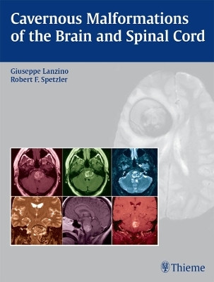 Cavernous Malformations of the Brain and Spinal Cord(English, Electronic book text, unknown)