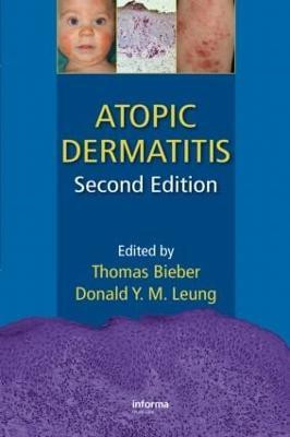 Atopic Dermatitis(English, Hardcover, unknown)