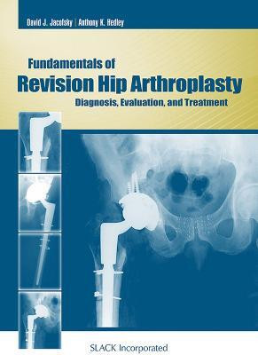 Fundamentals of Revision Hip Arthroplasty(English, Hardcover, Jacofsky David)