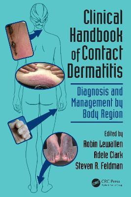 Clinical Handbook of Contact Dermatitis(English, Electronic book text, unknown)