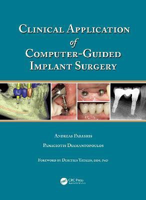 Clinical Application of Computer-Guided Implant Surgery(English, Electronic book text, Parashis Andreas)