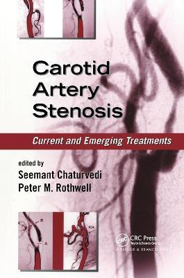 Carotid Artery Stenosis(English, Paperback, unknown)