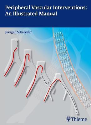 Peripheral Vascular Interventions: An Illustrated Manual(English, Hardcover, Schroeder Juergen)