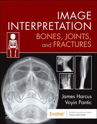 Image Interpretation: Bones, Joints, and Fractures(English, Paperback, Harcus James)