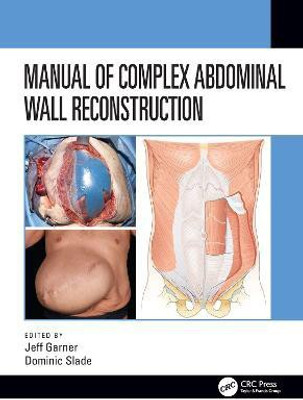 Manual of Complex Abdominal Wall Reconstruction(English, Hardcover, unknown)