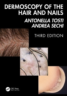 Dermoscopy of the Hair and Nails 3e(English, Hardcover, Tosti Antonella)