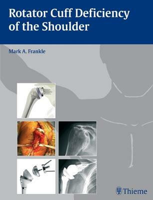 Rotator Cuff Deficiency of the Shoulder(English, Hardcover, unknown)
