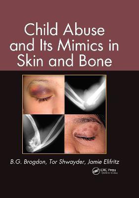 Child Abuse and its Mimics in Skin and Bone(English, Electronic book text, Brogdon B. G.)