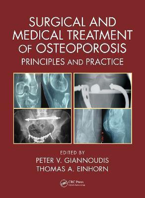 Surgical and Medical Treatment of Osteoporosis(English, Hardcover, unknown)