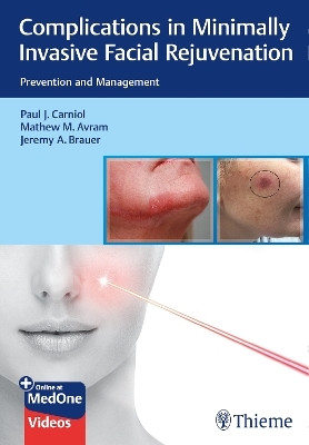 Complications in Minimally Invasive Facial Rejuvenation(English, Mixed media product, Carniol Paul J.)