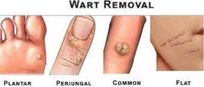 Luipui best wart remover cream for skin tag(1 Items in the set)