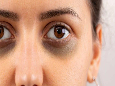 WOONGMI Eye Cream Removes Dark Circles and Puffiness(50 g)