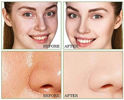 Jiwoo ALL skin tone and pimpel remove(50 g)