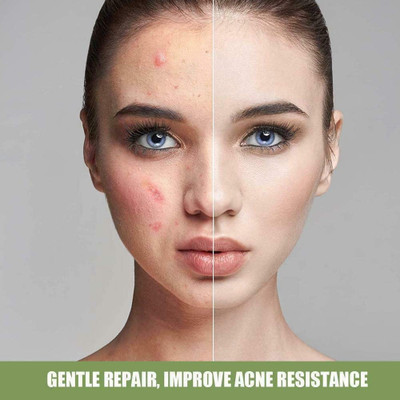 GABBU Acne Removal Salicylic Acid Ice Cream Mask For Both Men And Women(120 ml)