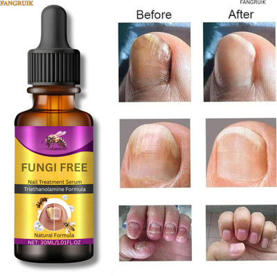 Fangruik Soothing Relief Oil for Toe Nail Pain Therapy Liquid(30 ml)