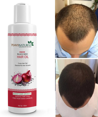 7days natural Onion Hair Growth Oil for Stronger Roots and Accelerated Hair Growth Hair Oil(200 ml)