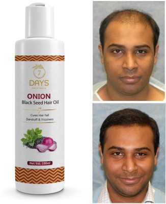 7 Days Red Onion Hair Oil Controls Hair Fall - No Mineral Oil Hair Oil(100 ml)