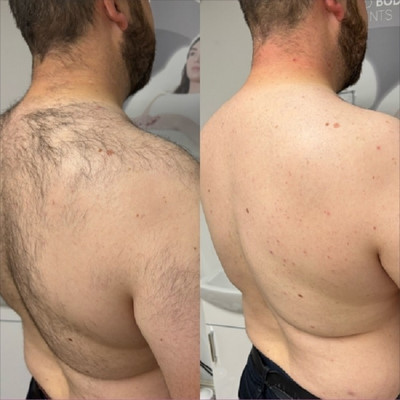 Bijlan Cosmetic Permanent Hair Removal Sprey For All Spray(100 ml)