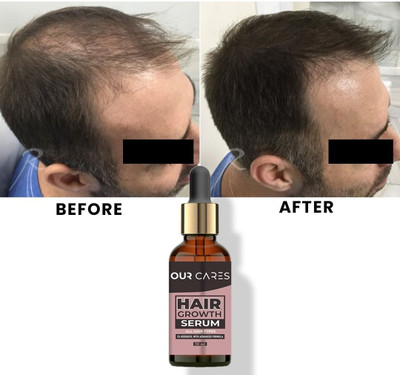 Ourcares Ultimate Hair Revitalization: Advanced Growth Serum with Redensyl & Anagain(50 ml)