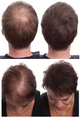 Latixmat Hair Building Fibers For Thin Hair Concealer & Volumizer For Men And Women(25 g)