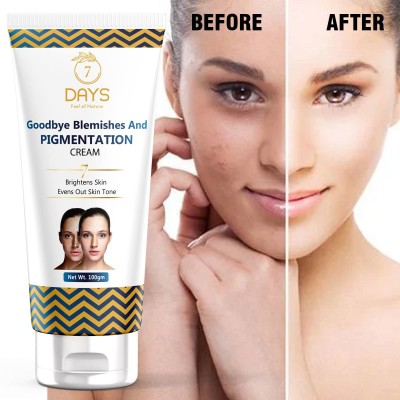 7 Days Pigmentation removal cream for women Acne Scar Removal Dark Spots Stretch Marks(100 g)
