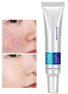 YAWI Best Anti Acne Cream Oil Control Shrink Pore Acnes Scar Remove(30 g)