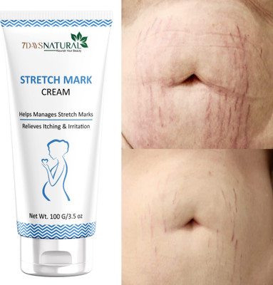 7days natural stretch marks remover cream for men stretch marks oil for men and women(100 g)