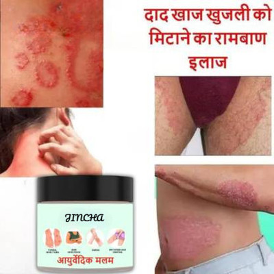 JINCHA Anti Fungal Cream For Men & Women (50*2 g)(100 g)