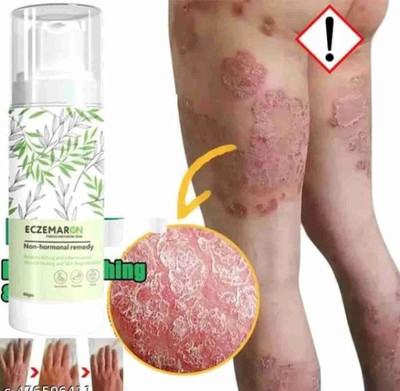 Etszaz Ayurvedic ItchCoat Anti fungal Malam for Ringworm itching Eczema cream(50 g)