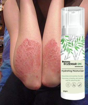buewey eczema anti fungal cream with cleaning spray nens n(50 ml)
