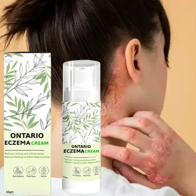 Ontario Herbal Eczemaron Cream PACK OF 1.5(50 g)