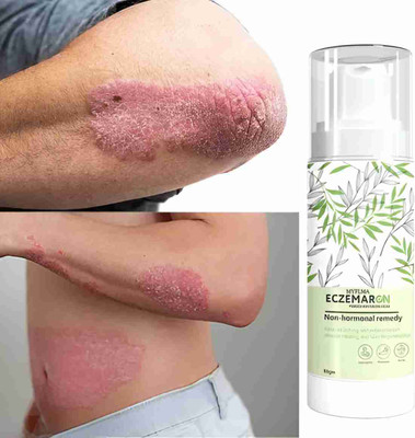 Etszaz Eczemaron Fungal Cream for Quick Relief from Fungal Infections(50 g)