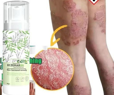 Edith Eczemaron Anti Fungal Cream For Men & Women(50 ml)