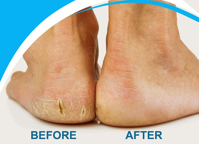 YAWI Crack Cream For Dry Cracked Heels & Feet(50 g)
