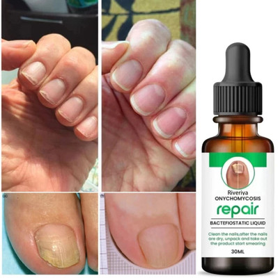 MOTYL Fungal Nail Treatment Liquid | Repair & Removal Solution for Nails (PACK OF 1) CLEAR