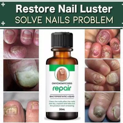 Vedlekha Nail Fungus Treatment Repair Foot Removal Toe Fungal Infection Liquid for nails(30 ml)
