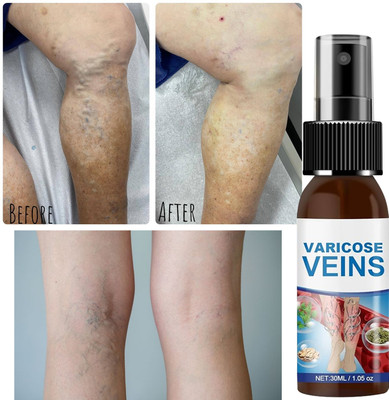 house of common Herbal Vein Support Spray – Varicose Vein Pain & Swelling Care Spray(30 ml)