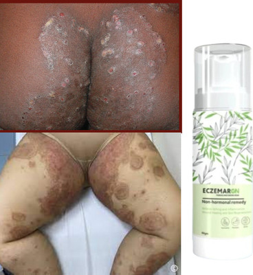 Elatiz Eczemaron Anti-Fungal Cream: Rapid Healing for Skin(50 ml)
