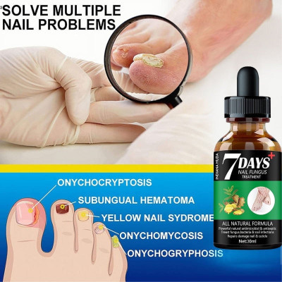 INDIANA HUDA 7 Days Nail Fungus Treatment Solution 30ml | Kill Fungus Naturally Fast(30 ml)