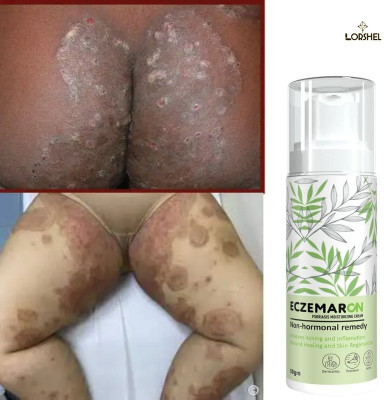 LORSHEL Eczemaron Anti Fungl Cream Relief from Fungal Infections with Antifungal Solution(50 ml)