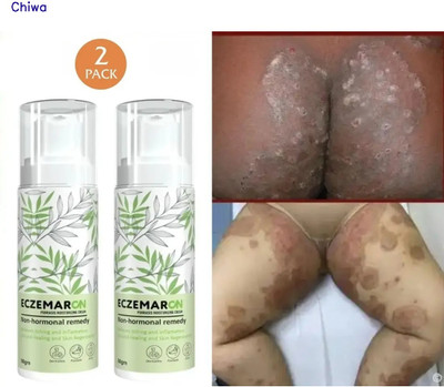 CHIWA Eczmaron Anti Fungal Cream | Soothing Balm For Skin(100 g)
