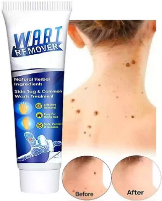 HUZURLU Wart Remover Ointment, Wart Remover Cream For Wart Removal(100 g)
