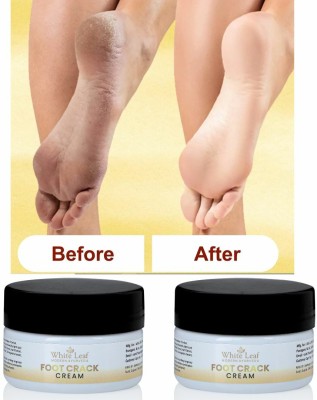 White Leaf Foot Crack Cream Crack Blaster Repair - Cracked Skin, Heel, Finger (Pack Of 2)(100 g)