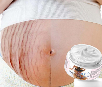 tanvi27 Powerful Marks Scar Postpartum Cr Stretch Pregnancy Body Precious Remover(50 g)