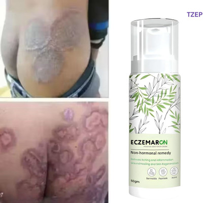 TZEP Eczemaron anti fungal cream quick relief from fungal burning and itching(50 ml)