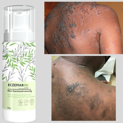 Eczemaron Ringworm Anti Fungal Cream with brightening skin For Men ...